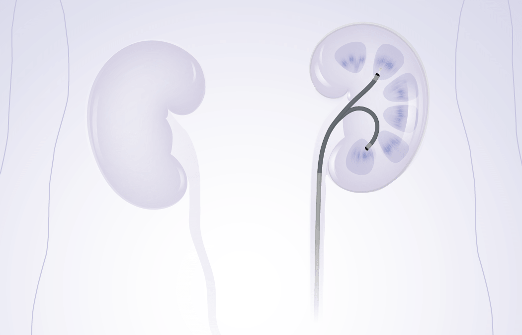 Single-Use Ureteroscope - Image 2